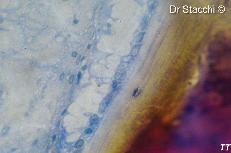 16. Detail of Fig. 11: an active site of bone formation, as indicated by the presence of an osteoid rim, is represented at higher magnification (1000× - courtesy Prof. Tonino Traini)