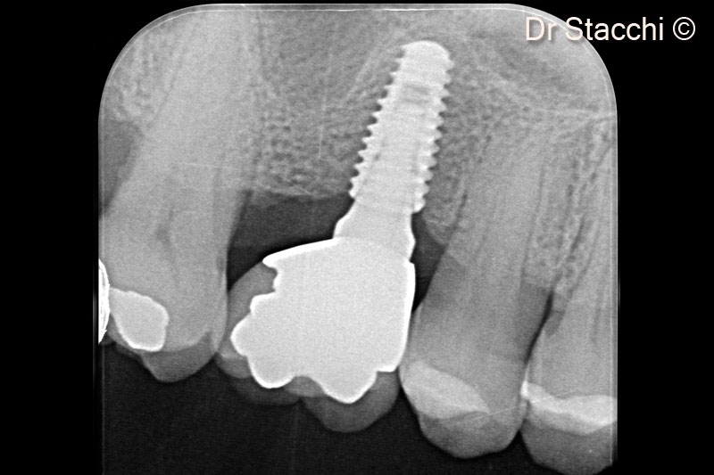 17. Three-year post loading follow up X-ray, demonstrating marginal bone stability and maturation of the grafted area