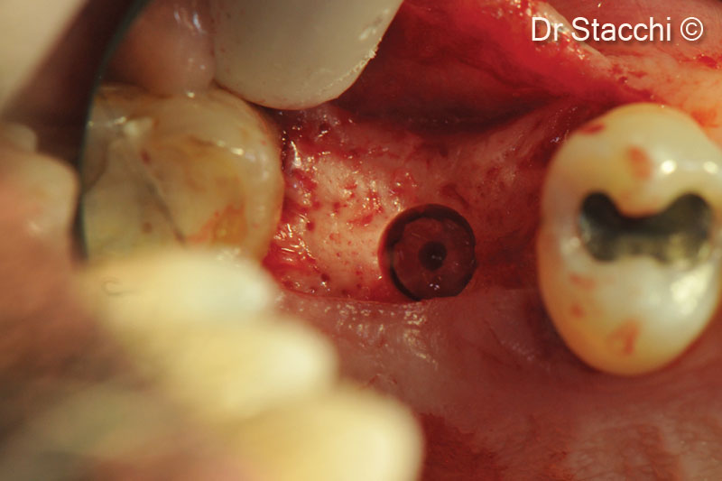 2. After raising a minimally invasive full thickness flap, the crestal access was performed mesially to the septum