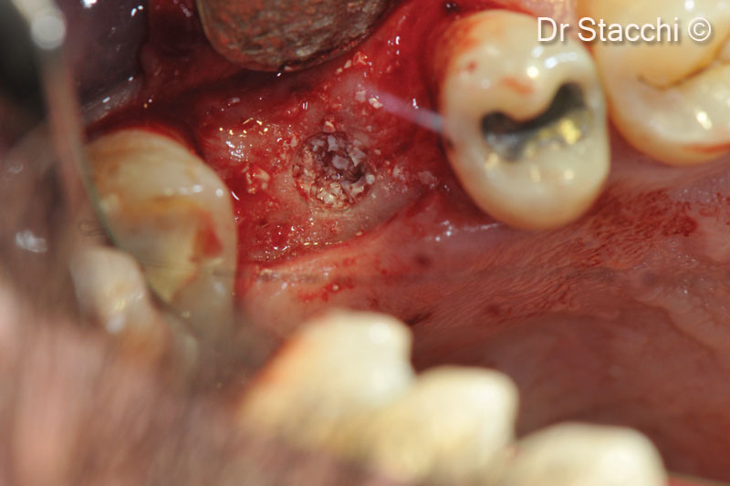 5. Sinus was grafted by condensing gradual increments of xenogeneic granules with osteotomes, until a minimum height of 10 mm was obtained (comprising the residual bone crest)