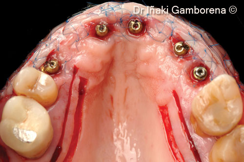 9. The strip gingival autograft technique was selected in order to blend the gingival color with the rest of the soft tissues in conjunction with xenogenic collagen matrix OsteoBiol® <i>Derma</i>/X-fine