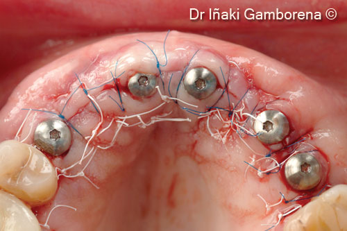 7. Crestal tuberosity connective tissue graft + connection of multiunits and corresponding healing abutments