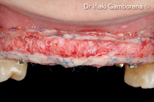 9. The strip gingival autograft technique was selected in order to blend the gingival color with the rest of the soft tissues in conjunction with xenogenic collagen matrix OsteoBiol® <i>Derma</i>/X-fine