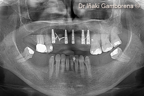 6. Panoramic x-ray of the osseous surgery.