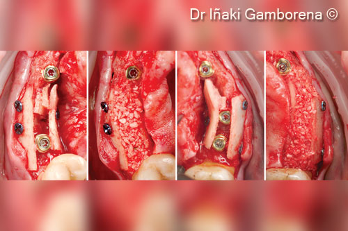4. From left to right implant placement N1 Nobel Biocare plus screwed hard OsteoBiol® <i> Lamina® </i> plates and 50% autogenous bone + 50% xenogenic bone material (OsteoBiol® <i>Apatos®</i>)