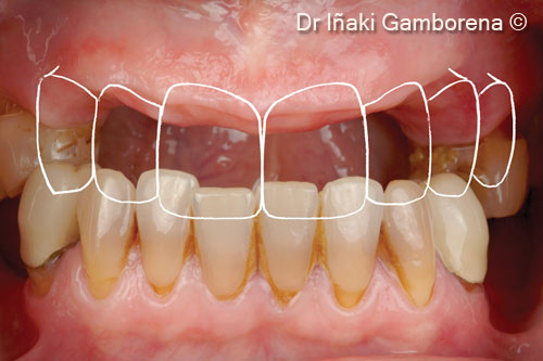 3. Virtual representation of the full contour wax-up and the presence of the defects