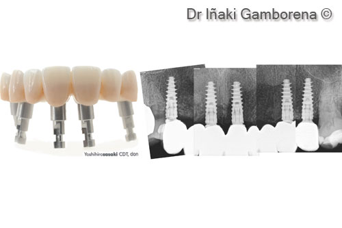 10. Final zirconia screw retained Nobel Biocare Procera implant bridge with corresponding x-ray