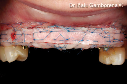 9. The strip gingival autograft technique was selected in order to blend the gingival color with the rest of the soft tissues in conjunction with xenogenic collagen matrix OsteoBiol® <i>Derma</i>/X-fine