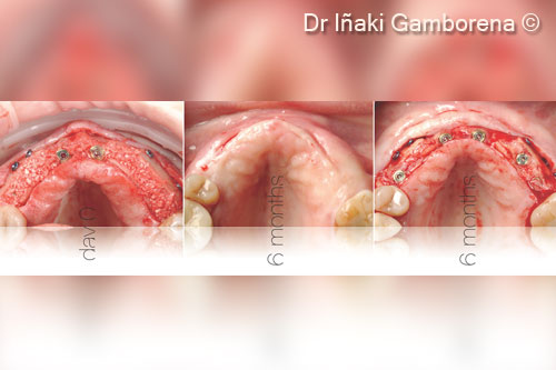 5. From left to right, day 0 of the surgery to 6 months uncovery. We can appreciate the nice integration of the hard lamina into the grafted bone