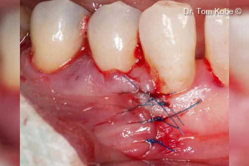 Fig. 7 Wound sutured with interrupted sutures