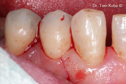 Fig. 3 Horizontal incision at the adjacent tooth