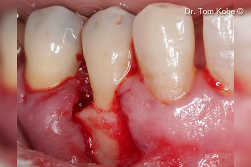 Fig. 4 Access to the defect