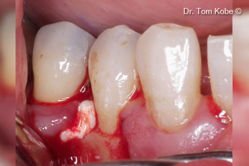 Fig. 6 Defect filled with OsteoBiol®  <i> Gel 40 </i> 