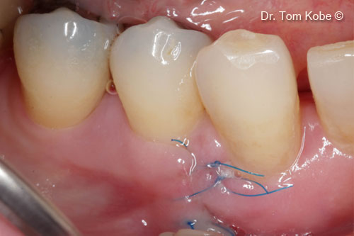 Fig. 8 Complete wound closure after one week