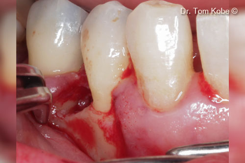 Fig. 5 Root scaling and debridement