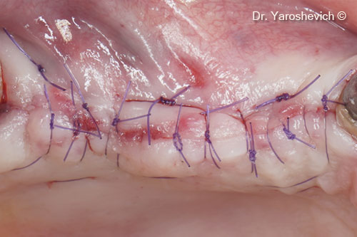 6. Soft tissues sutured with double simple 6/0 sutures 