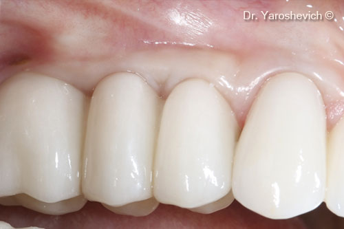 13. In 2 months, the patient underwent prosthetic treatment after a screw-retained zirconia crowns had been made