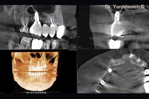 15. After analyzing the alveolar ridge horizontally, as observed 2 years post-op, the bone width around the #16 implant remained stable