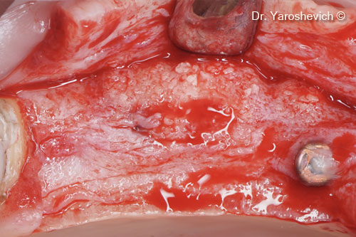 8. Full-thickness flap elevated (during the second stage). Increase in bone width observed 6 months after augmentation