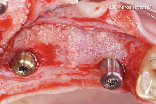 10. Homogenous bone around the healing abutment with 8-mm of bone width observed