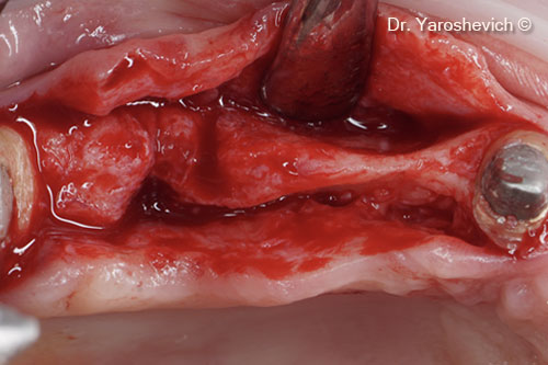 2. In the posterior maxilla, a full-thickness, slightly buccal incision was in the keratinized gingiva