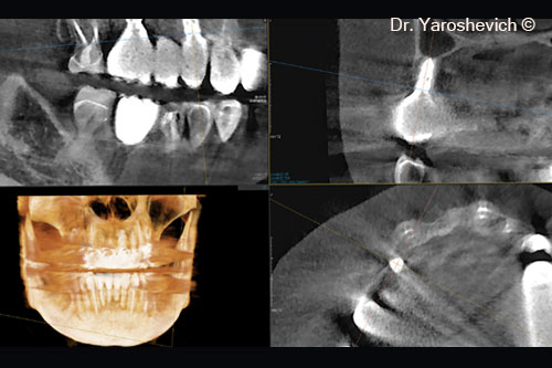 14. After 2 years, a new CBCT scan performed to evaluate the alveolar ridge around #14 implant horizontally