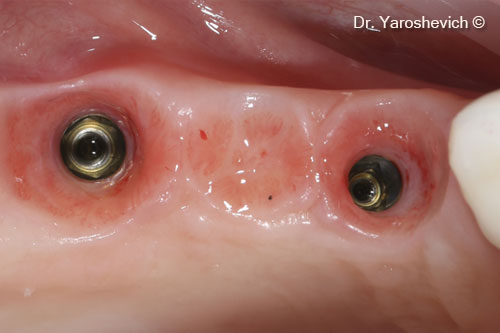 12. Postoperative occlusal view