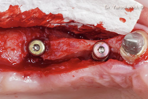 3. Two implants successfully placed at sites #14 and #16, with good primary stability. Instead of a cover screw, a 3-mm healing abutment was used 