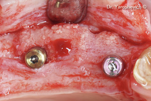 9. 3-mm healing abutments replaced with 5-mm healing abutments