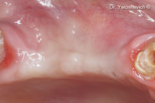 7. Intraoral view after 6 months