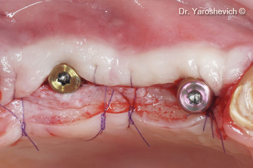 11. Soft tissues sutured with figure 8 sutures