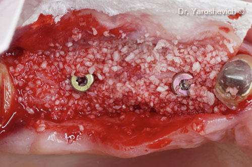 4. Collagenated cortico-cancellous bone mix Gen-Os® placed buccally and lingually on the defect site