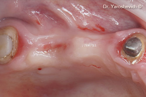 1. Initial intraoral view. Site with a ridge contour deficit 