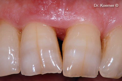 1. localized periodontal defect 11