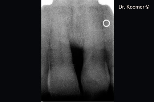 3. initial x-ray