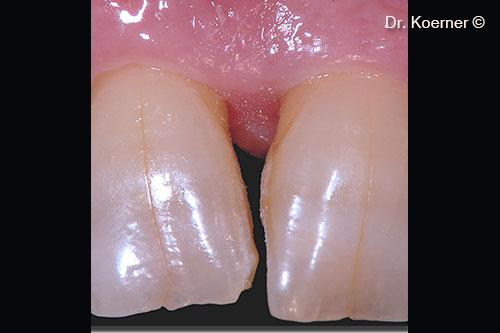 9. removal of splinting before interproximal restauration