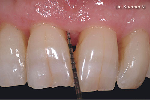 7. clinical situation 4 months post-op with splinting