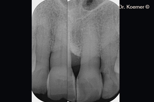 12. x-ray situation 10 years post-op