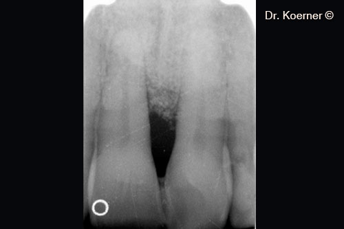 8. x-ray situation 4 months post-op with splinting