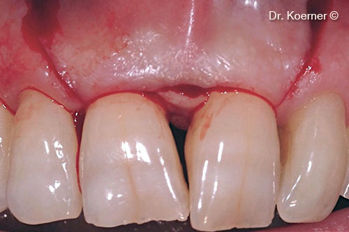 4. incision following the Modified Papilla Preservation Technique