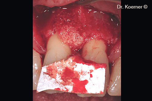 The Modified Papilla Preservation...