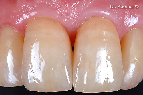 13. final restoration with ceramic veneers 13-23