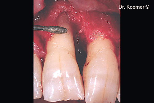 5. root planning with Piezo diamond tip