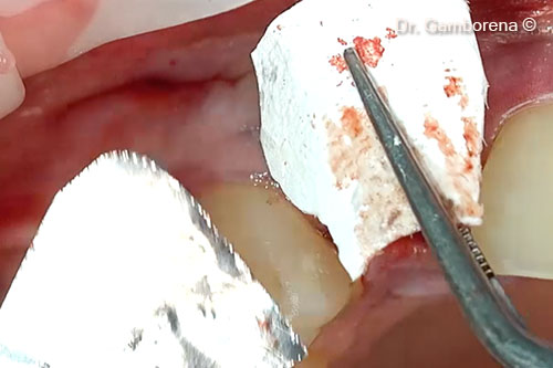 8. Regeneration of the buccal plate with Soft Lamina