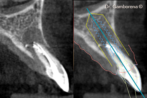 3. CBCT ad planning