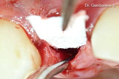 10. Placement of the Soft Lamina (palatal)