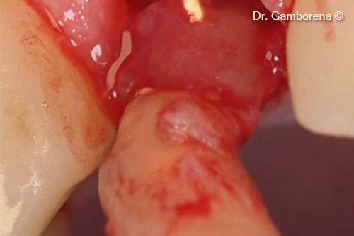 4. Extraction. It is possible to see a granuloma