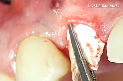 9. Placement of the Soft Lamina (buccal)