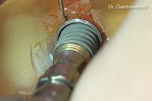 5. Implant placement