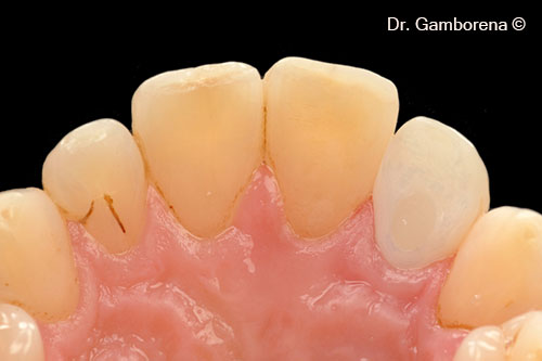 24.Palatal 1 year